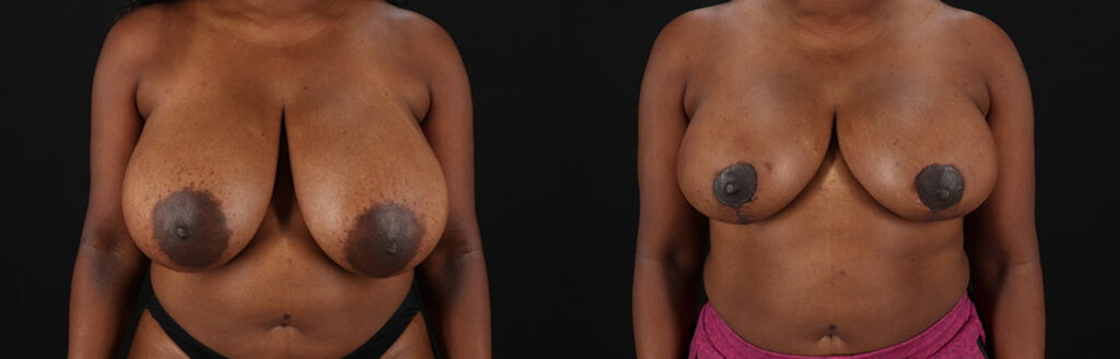 Breast Reduction Before and After Photo by Baylan Plastic Surgery in Houston, TX