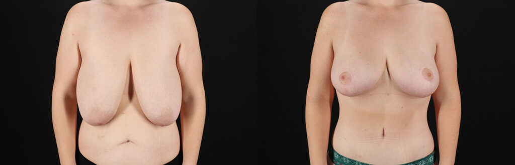 Breast Reduction Before and After Photo by Baylan Plastic Surgery in Houston TX